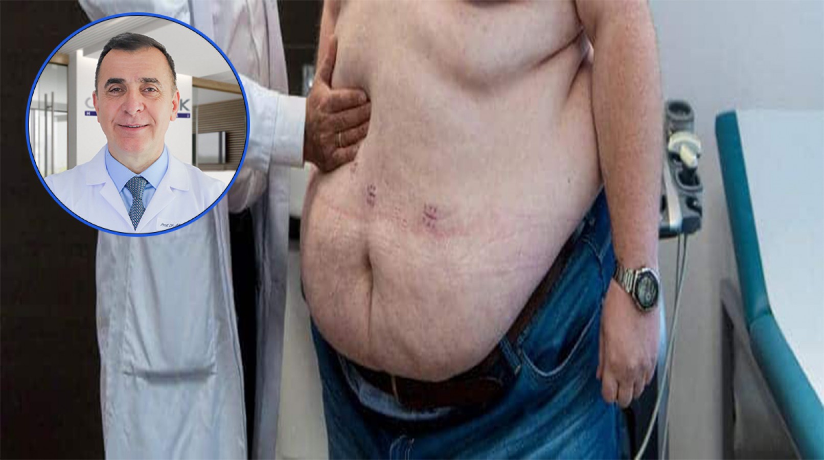 Obezitenin cerrahi tedavisinde ameliyat yöntemi